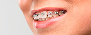 Dientes desalineados